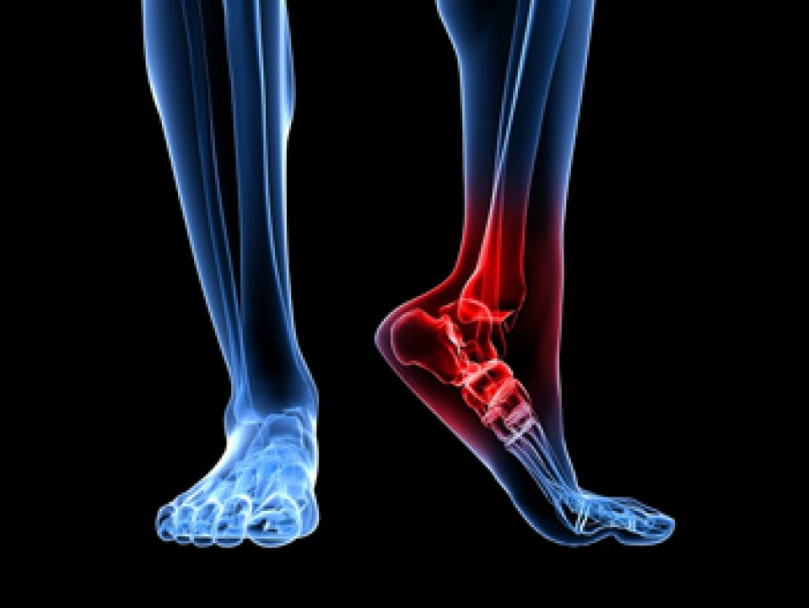 All About Heel Spurs: Causes, Treatments and Prevention — Westfield Foot  and Ankle, LLC