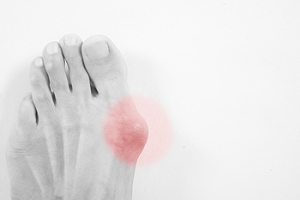 How Do Bunions Develop?